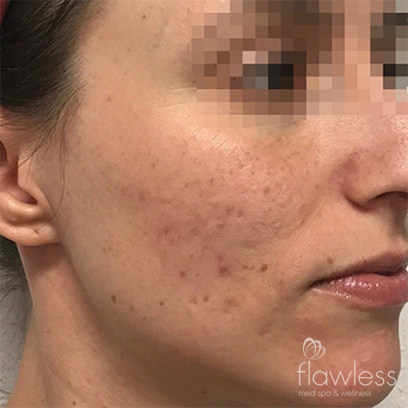 Acne Scar Repair Before & After Gallery - Patient 58202356 - Image 1