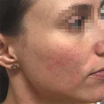 Acne Scar Repair Before & After Gallery - Patient 58202356 - Image 2