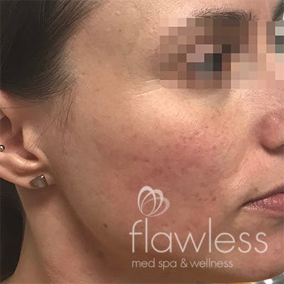 Acne Scar Repair Before & After Gallery - Patient 58202356 - Image 2
