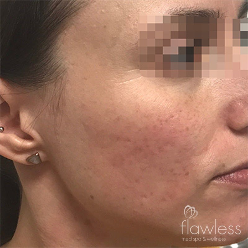 Acne Scar Repair Before & After Gallery - Patient 58202356 - Image 2