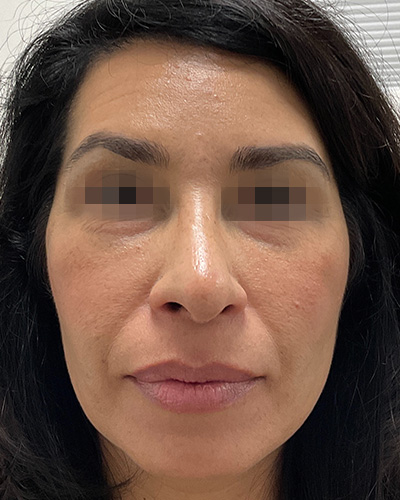 Cheek Filler Before & After Gallery - Patient 58202370 - Image 1