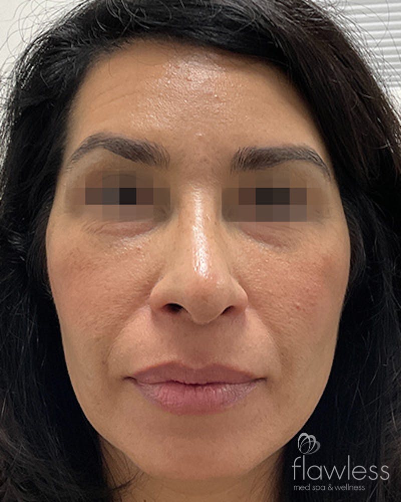 Cheek Filler Before & After Gallery - Patient 58202370 - Image 1