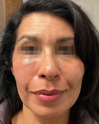 Cheek Filler Before & After Gallery - Patient 58202370 - Image 2
