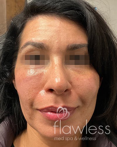 Cheek Filler Before & After Gallery - Patient 58202370 - Image 2