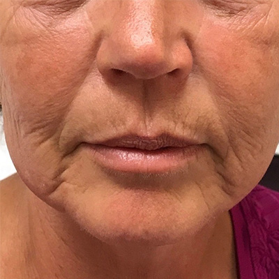 Cheek Filler Before & After Gallery - Patient 58202369 - Image 1