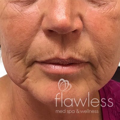 Cheek Filler Before & After Gallery - Patient 58202369 - Image 1