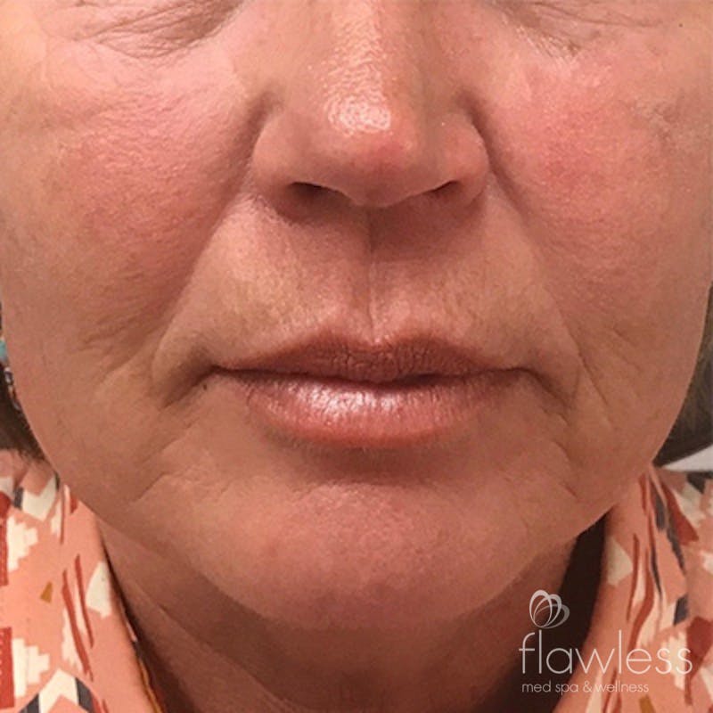 Cheek Filler Before & After Gallery - Patient 58202369 - Image 2