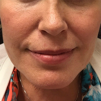 Cheek Filler Before & After Gallery - Patient 58202368 - Image 1