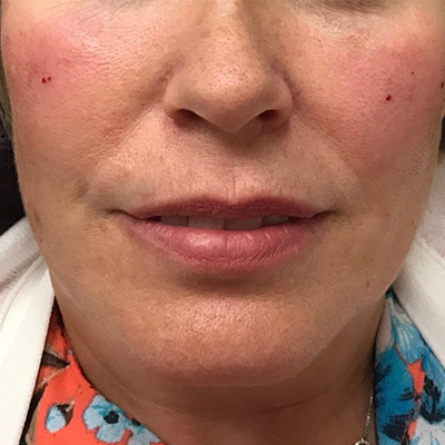 Cheek Filler Before & After Gallery - Patient 58202368 - Image 2