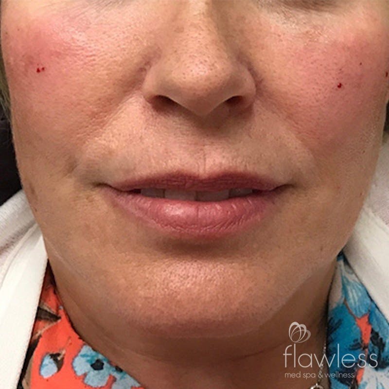Cheek Filler Before & After Gallery - Patient 58202368 - Image 2