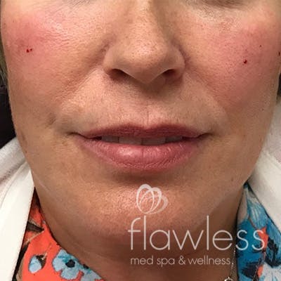 Cheek Filler Before & After Gallery - Patient 58202368 - Image 2