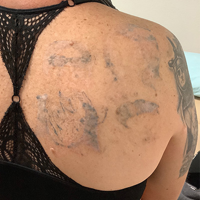 Laser Tattoo Removal Before & After Gallery - Patient 58202393 - Image 2