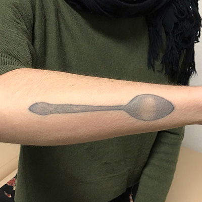 Laser Tattoo Removal Before & After Gallery - Patient 58202392 - Image 1