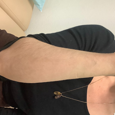 Laser Tattoo Removal Before & After Gallery - Patient 58202392 - Image 2