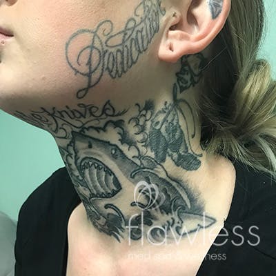 Laser Tattoo Removal Before & After Gallery - Patient 58202391 - Image 1