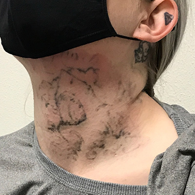 Laser Tattoo Removal Before & After Gallery - Patient 58202391 - Image 2