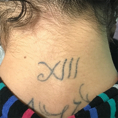 Laser Tattoo Removal Before & After Gallery - Patient 58202390 - Image 1