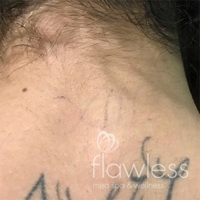 Laser Tattoo Removal Before & After Gallery - Patient 58202390 - Image 2