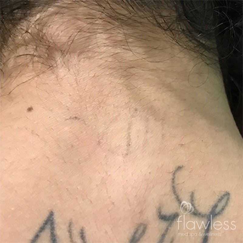 Laser Tattoo Removal Before & After Gallery - Patient 58202390 - Image 2
