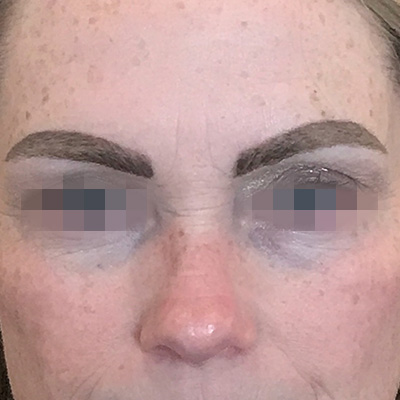 Laser Tattoo Removal Before & After Gallery - Patient 58202389 - Image 1