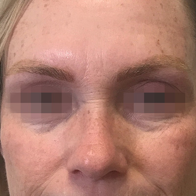 Laser Tattoo Removal Before & After Gallery - Patient 58202389 - Image 2