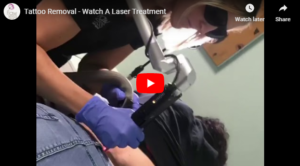 Flawless Medspa Blog | Tattoo Removal – Watch A Laser Treatment