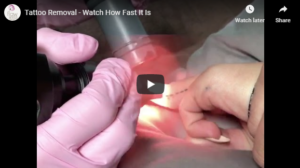 Flawless Medspa Blog | Tattoo Removal – Watch How Fast It Is