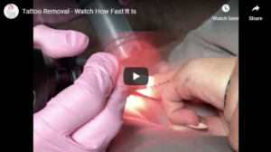 Flawless Medspa Podcast | Tattoo Removal – Watch How Fast It Is