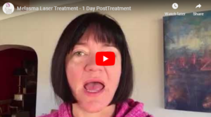 Flawless Medspa Blog | Melasma Laser Treatment – 1 Day Post Treatment