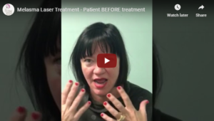 Flawless Medspa Blog | Melasma Laser Treatment – Patient BEFORE treatment