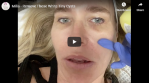 Flawless Medspa Blog | Milia – Remove Those White Tiny Cysts