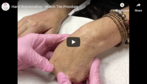 Flawless Medspa Podcast | Hand Rejuvenation – Watch The Procedure