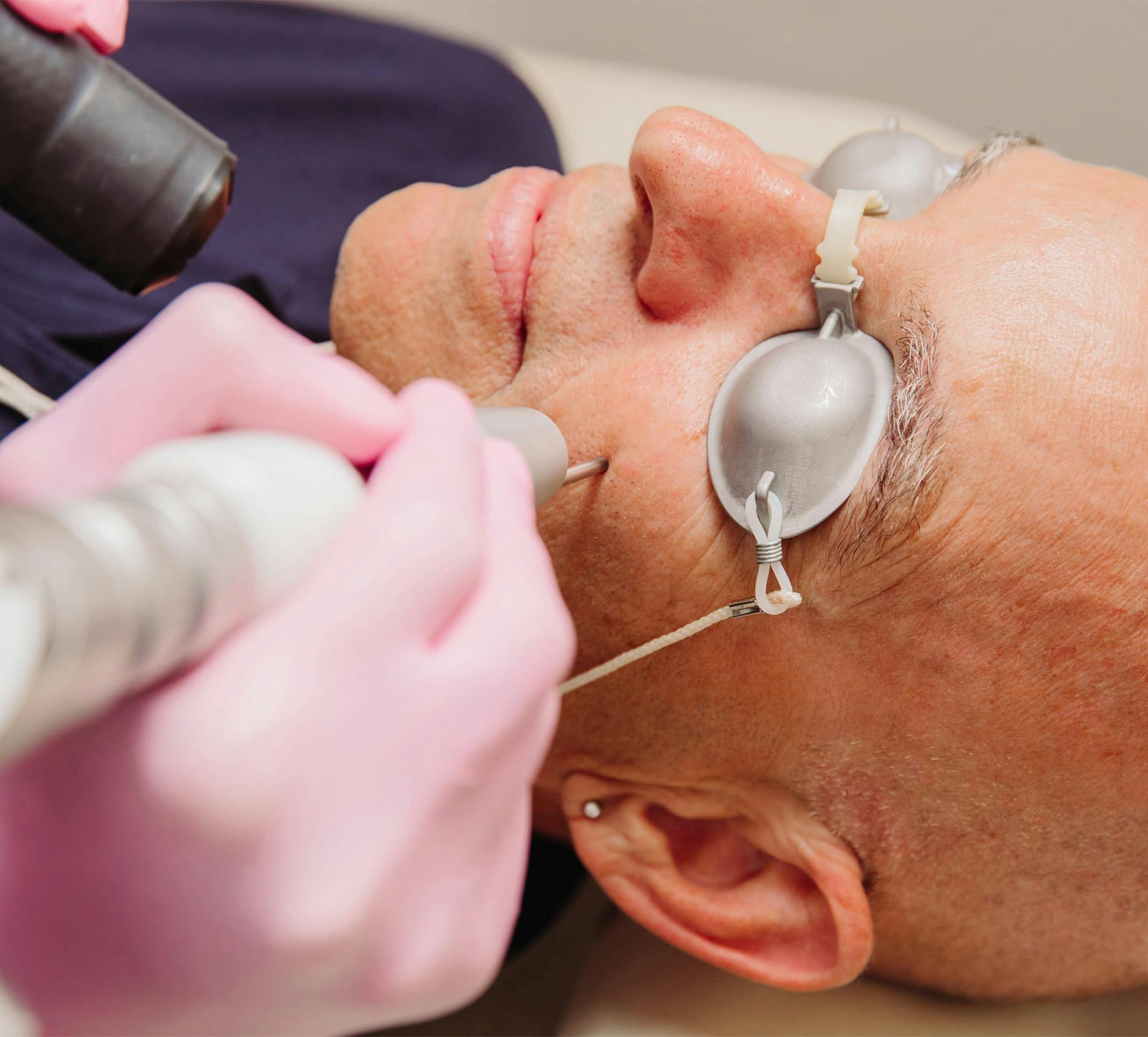person getting pico laser treatment
