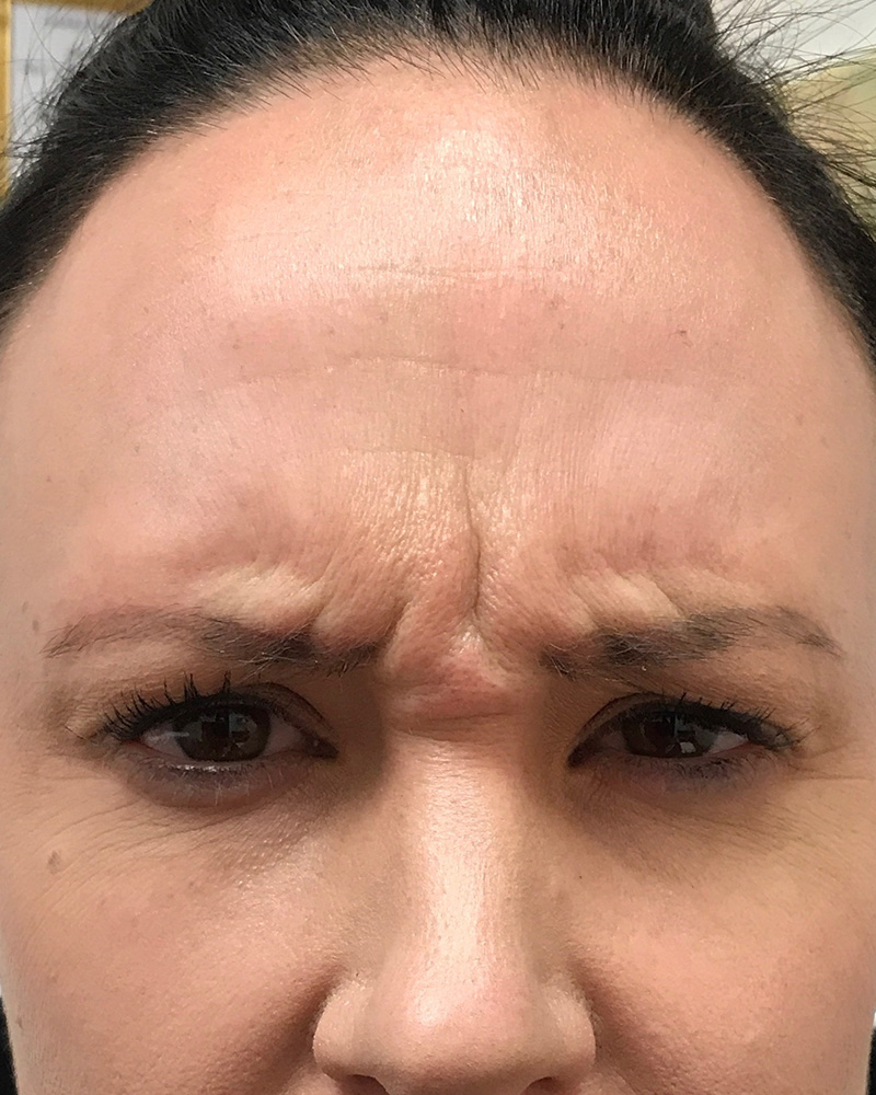 BOTOX Before & After Gallery - Patient 175045791 - Image 1