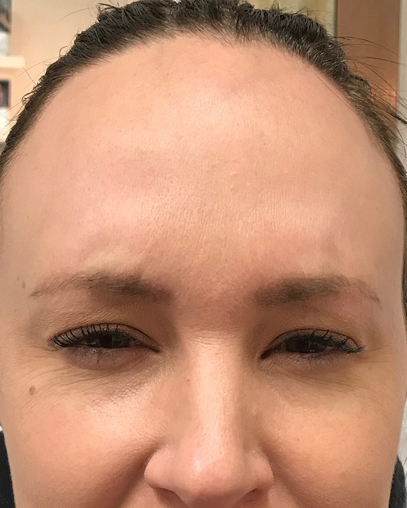 BOTOX Before & After Gallery - Patient 175045791 - Image 2