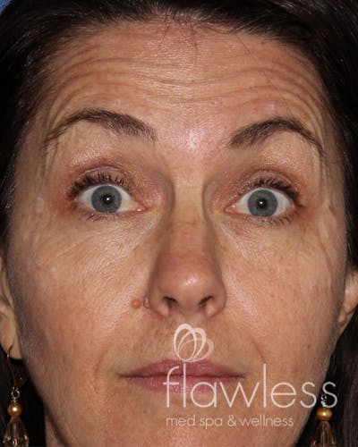 BOTOX Before & After Gallery - Patient 175045792 - Image 1