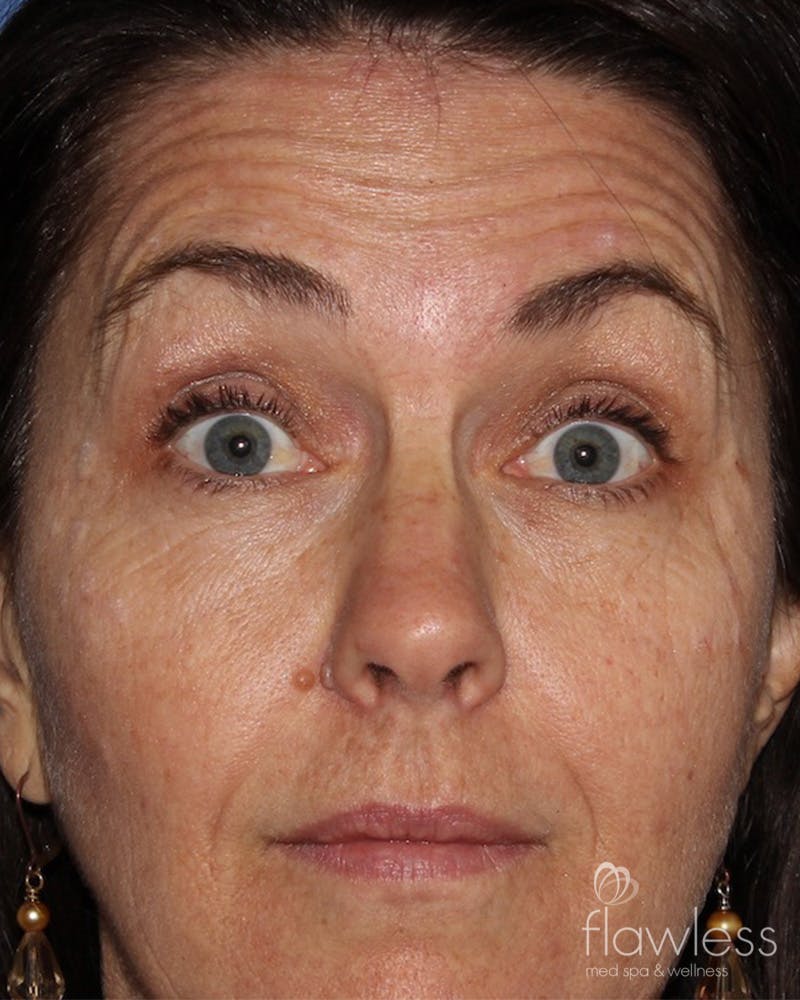 BOTOX Before & After Gallery - Patient 175045792 - Image 1