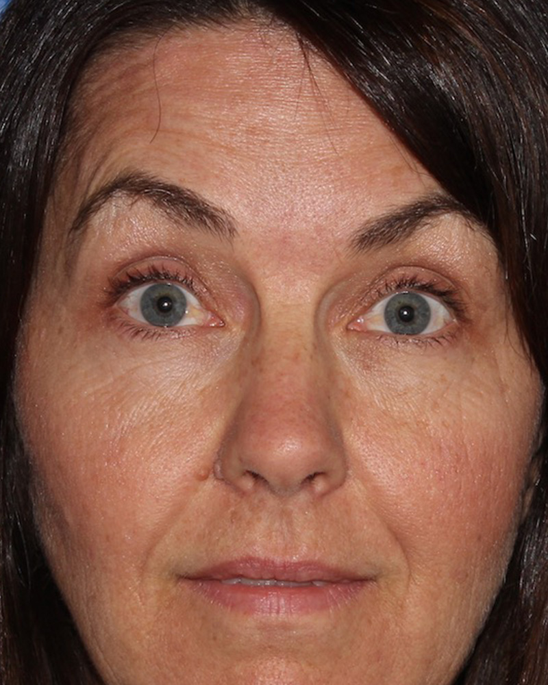 BOTOX Before & After Gallery - Patient 175045792 - Image 2
