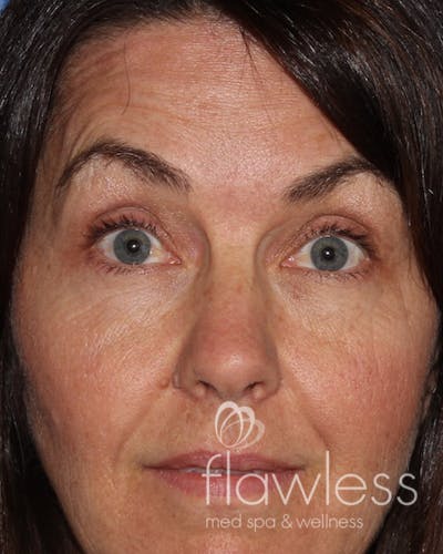 BOTOX Before & After Gallery - Patient 175045792 - Image 2