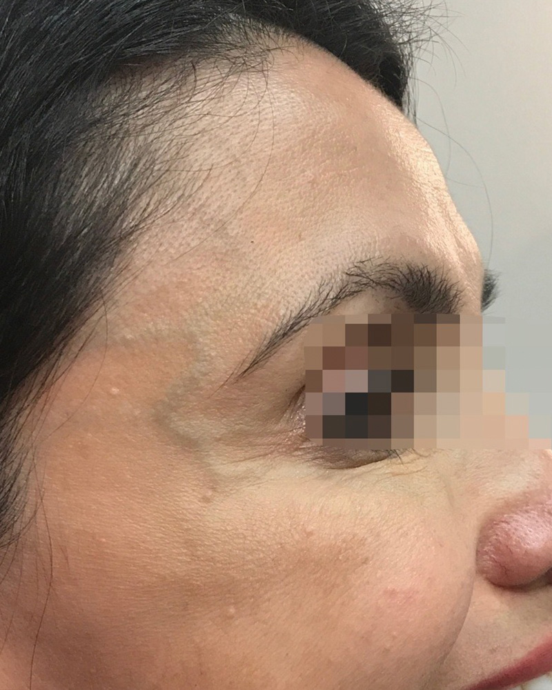 BOTOX Before & After Gallery - Patient 175045793 - Image 2