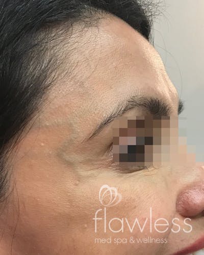 BOTOX Before & After Gallery - Patient 175045793 - Image 2
