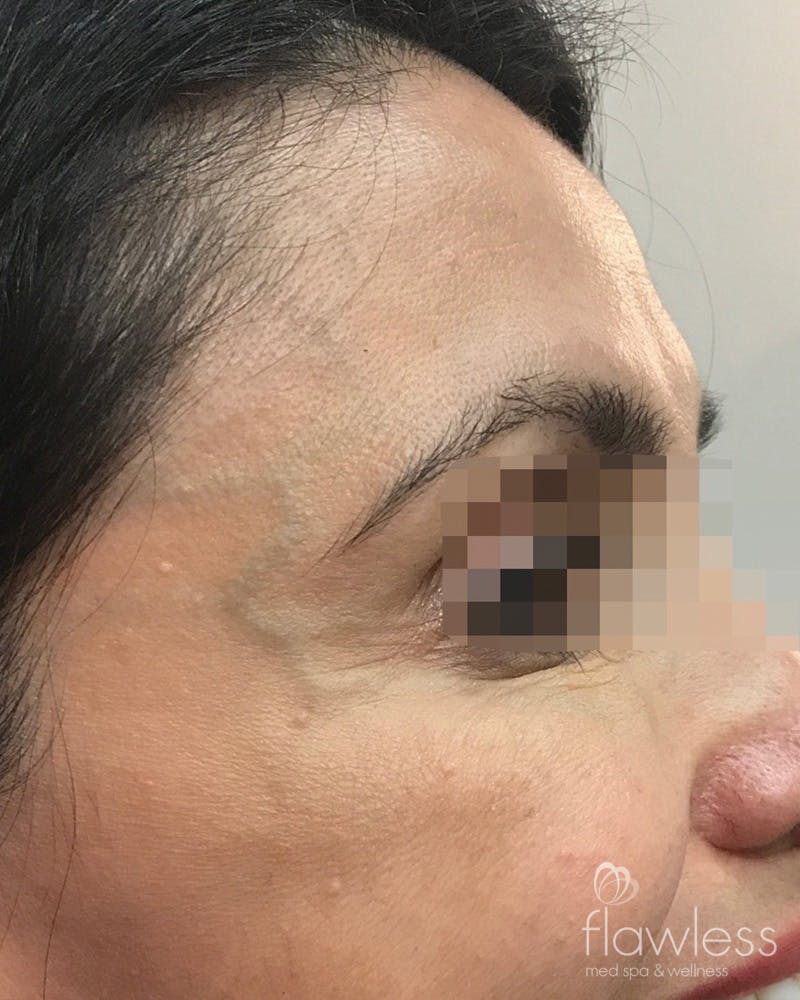 BOTOX Before & After Gallery - Patient 175045793 - Image 2