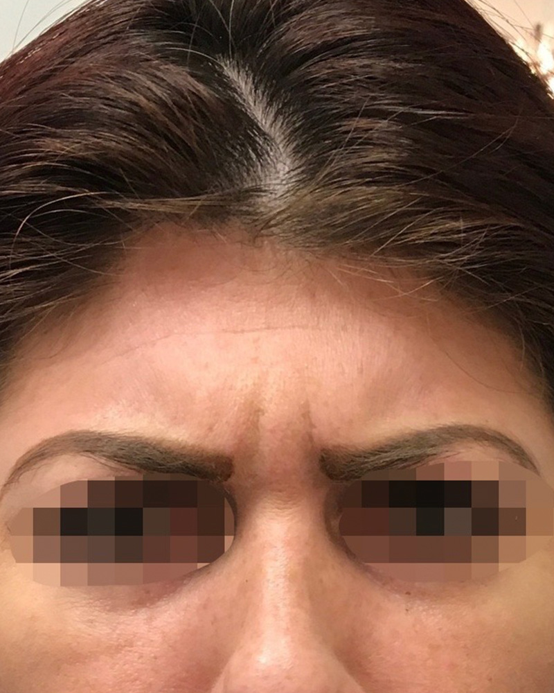 BOTOX Before & After Gallery - Patient 175045799 - Image 1