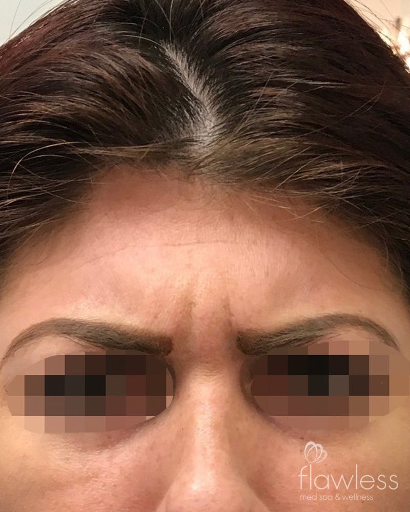 BOTOX Before & After Gallery - Patient 175045799 - Image 1
