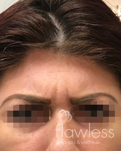 BOTOX Before & After Gallery - Patient 175045799 - Image 1