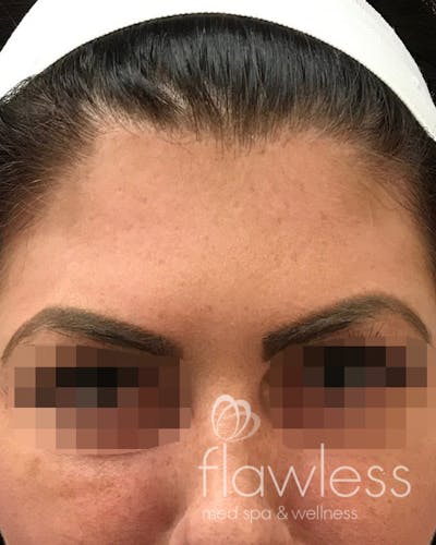 BOTOX Before & After Gallery - Patient 175045799 - Image 2