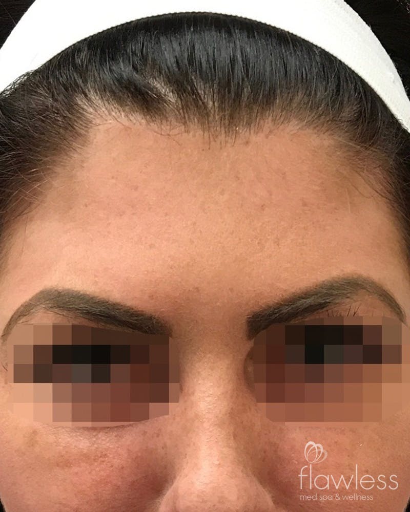 BOTOX Before & After Gallery - Patient 175045799 - Image 2