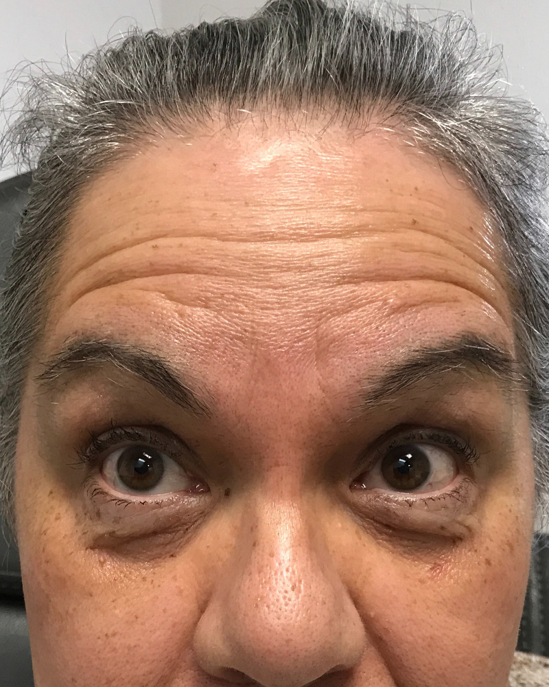 BOTOX Before & After Gallery - Patient 175045794 - Image 1