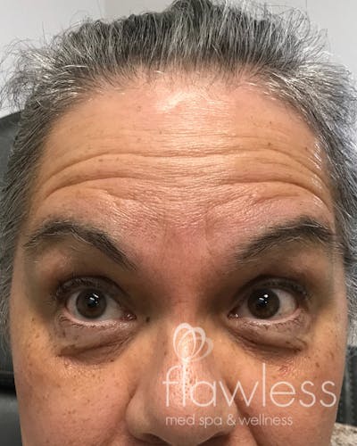 BOTOX Before & After Gallery - Patient 175045794 - Image 1