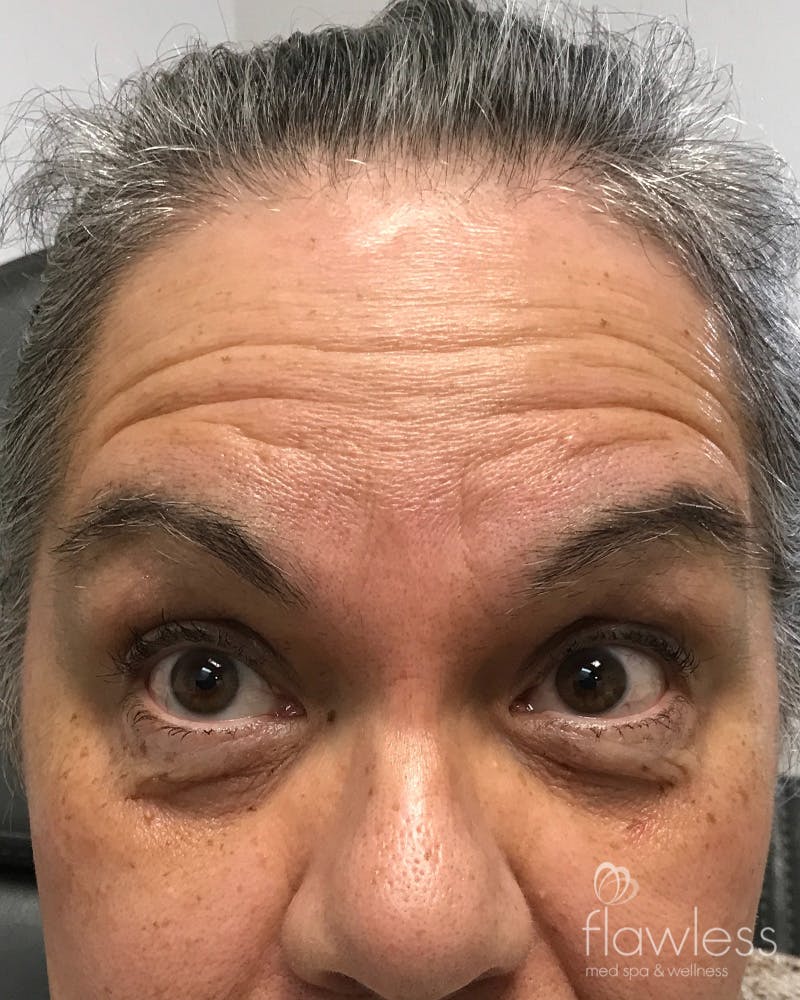 BOTOX Before & After Gallery - Patient 175045794 - Image 1